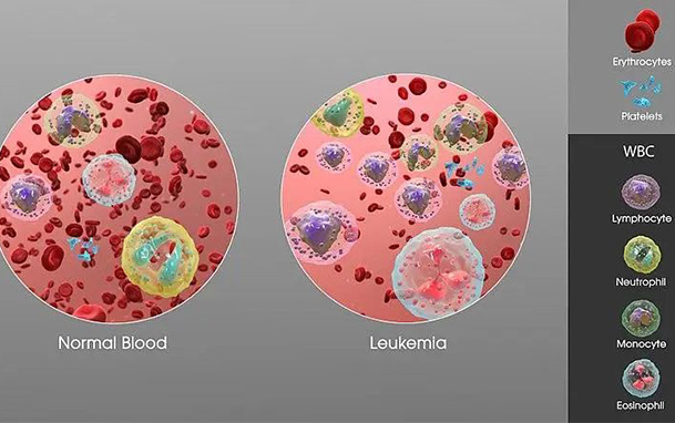 【专业科普】全球被治愈的4例艾滋病人：均经干细胞移植实现长期缓解